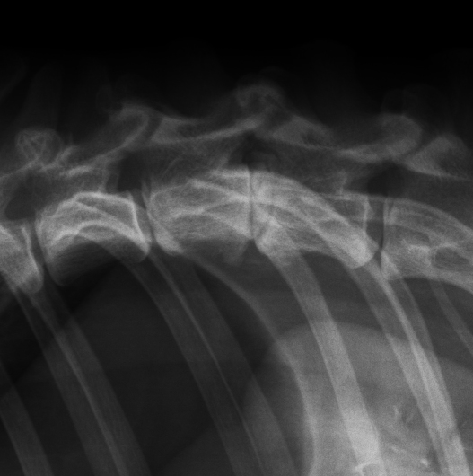 Röntgenbild Wirbensäule mit Bandscheibenvorfall